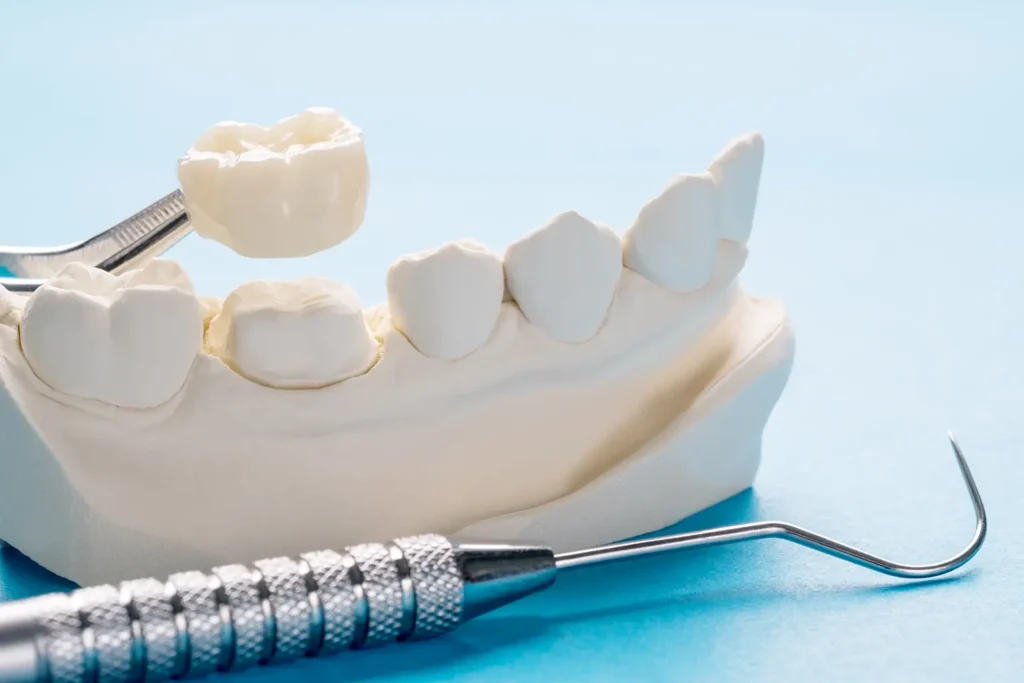 Image of Same-Day Permanent Tooth-Colored Crowns offered by Parkway Family Dental