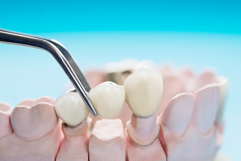 Image of a set of dental bridges from Parkway Family Dental