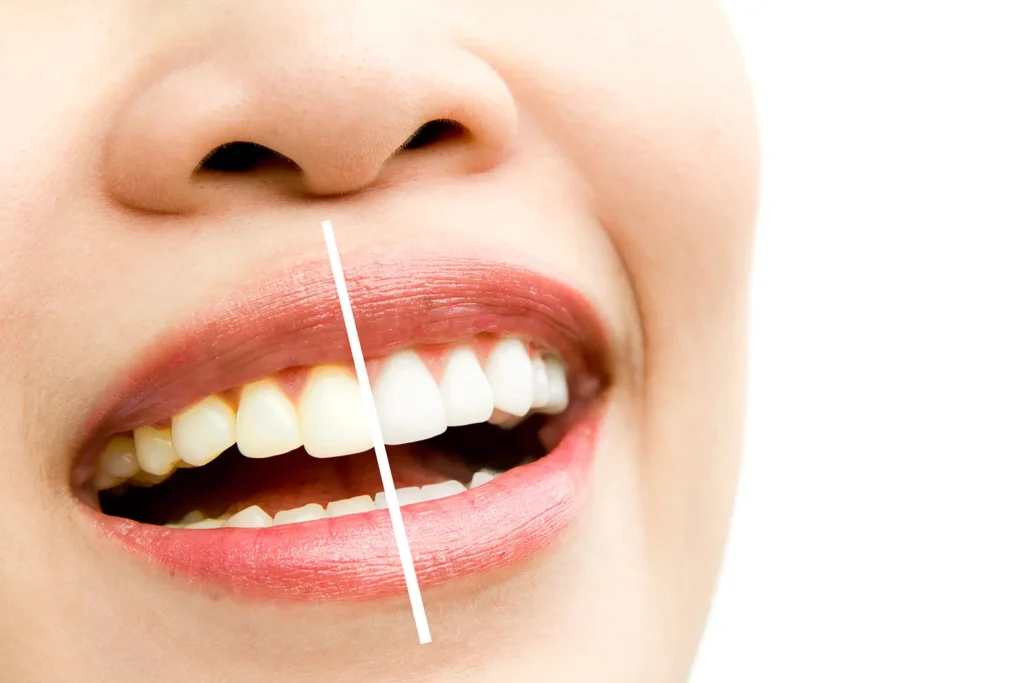 Woman smiling showing before and after teeth whitening process from Parkway Family Dental