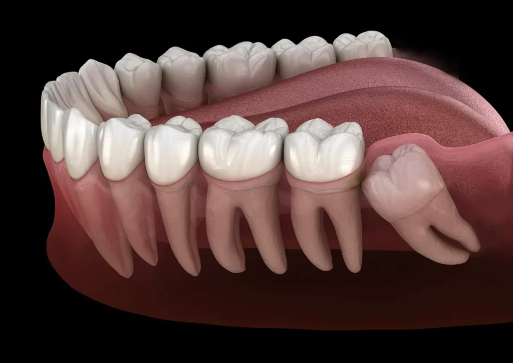 3D graphic of wisdom teeth; Wisdom teeth removal at Parkway Family Dental provides personalized care for painful, impacted, or problematic wisdom teeth in Kalispell, MT.