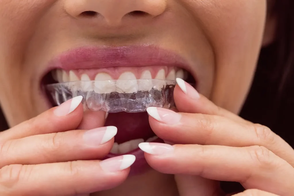 A woman wearing Clear Aligner Orthodontic Treatment from Parkway Family Dental