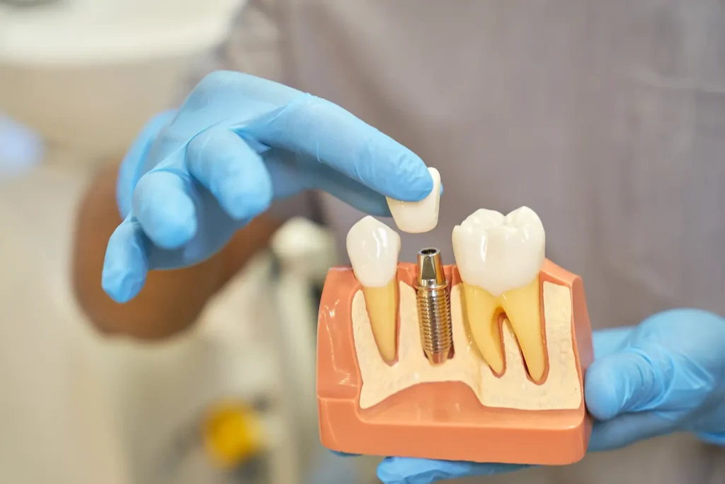 Image of a dental implant example showcasing the Surgical Dental Implant Placement process from Parkway Family Dental